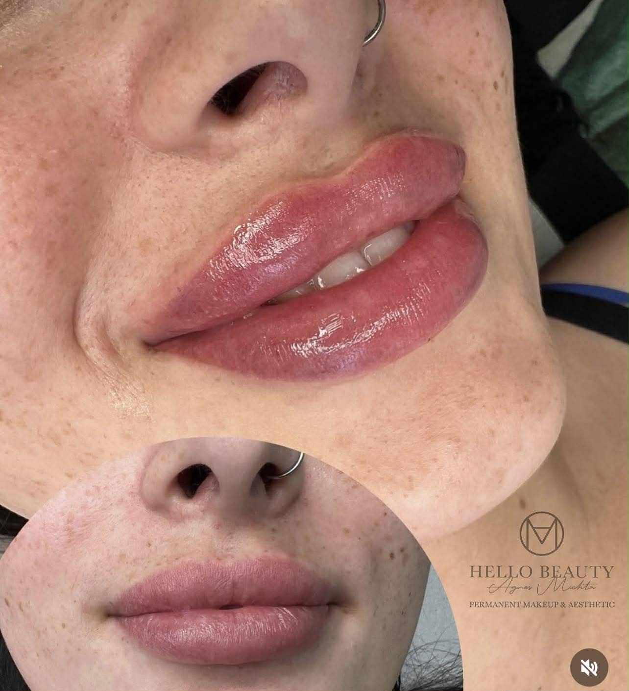 Modelowanie ust przed i po – transformacja Hello Beauty