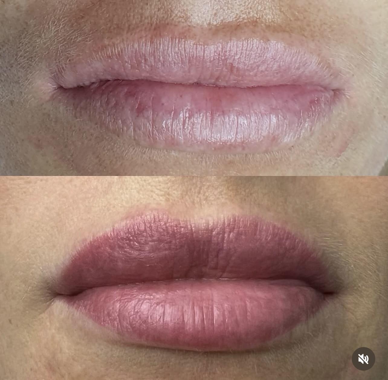 Wygojone usta permanentne przed i po – efekt Hello Beauty