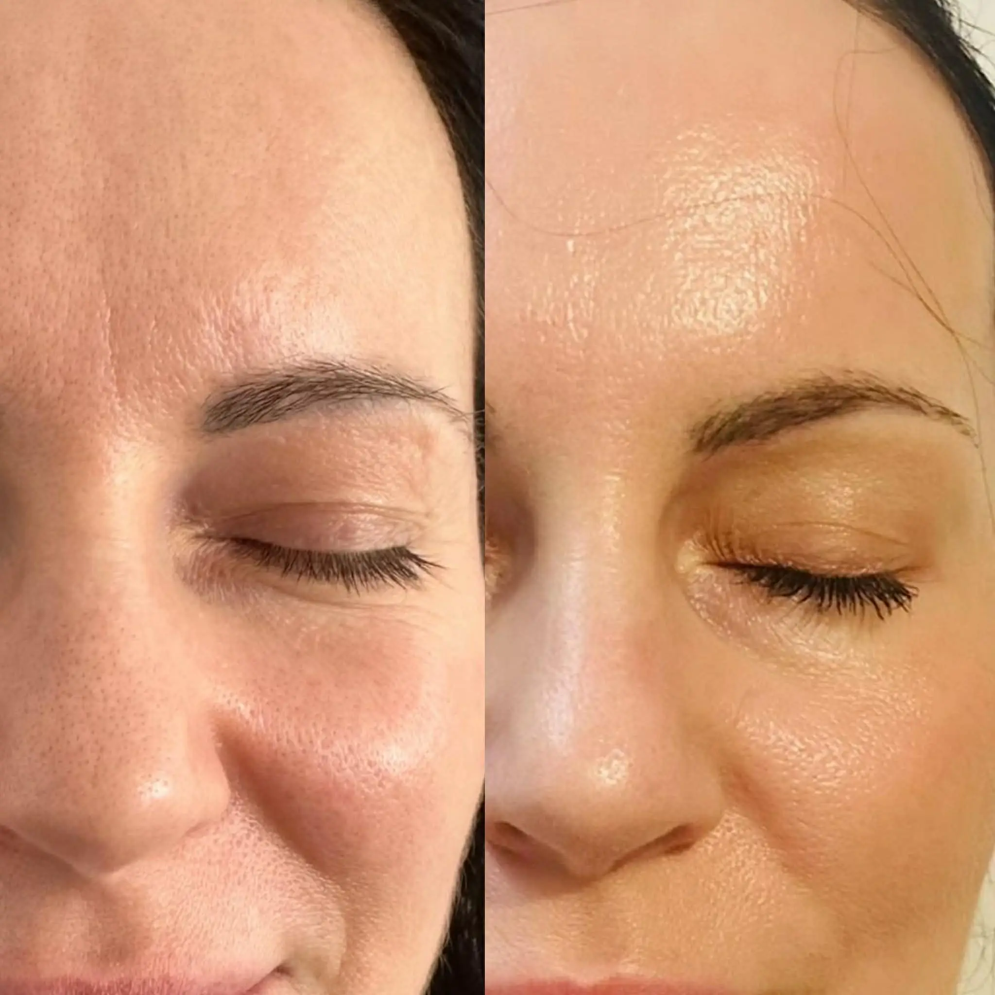 Laser tulowy przed i po – transformacja Hello Beauty Kołobrzeg