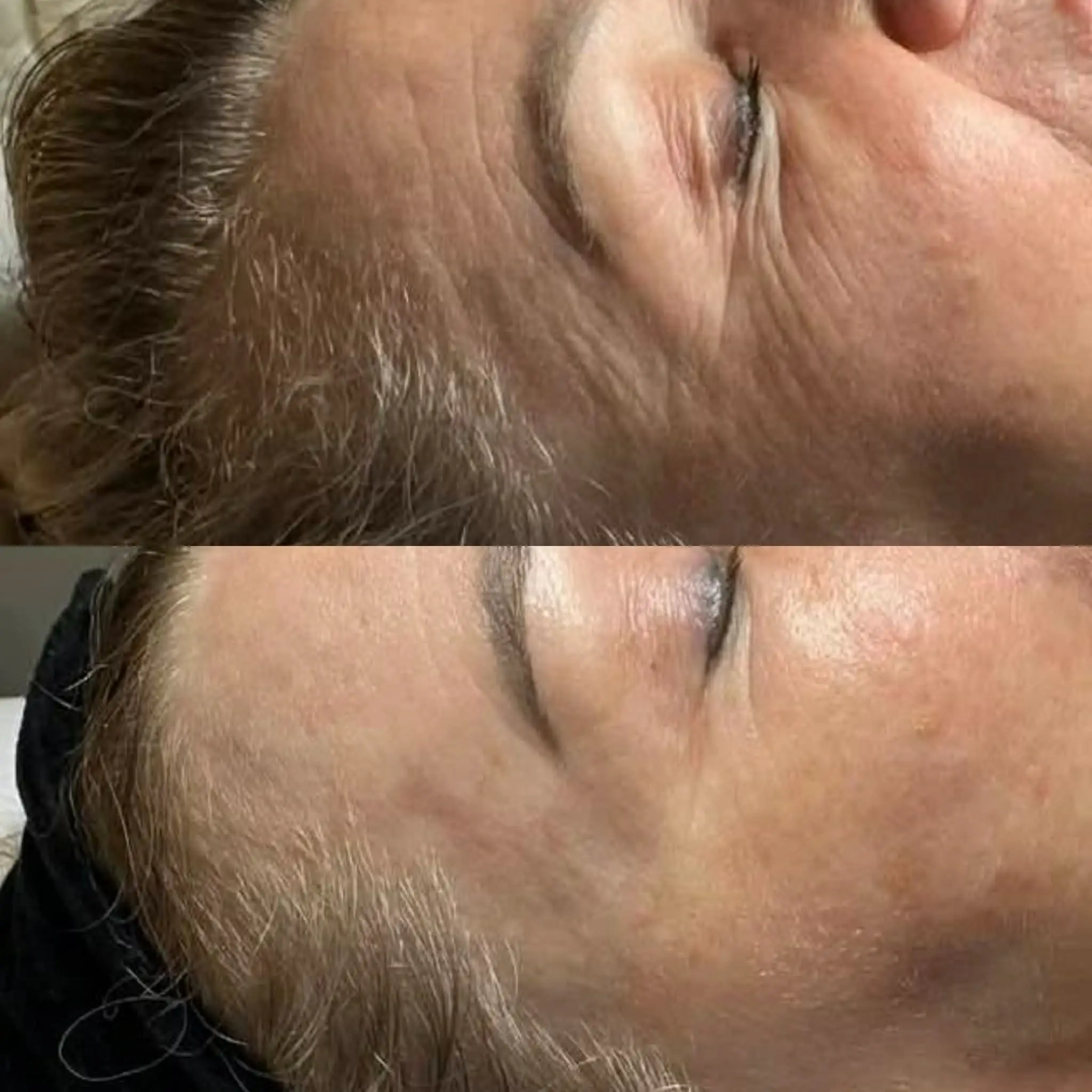 Laser tulowy efekt zabiegu – Hello Beauty Kołobrzeg