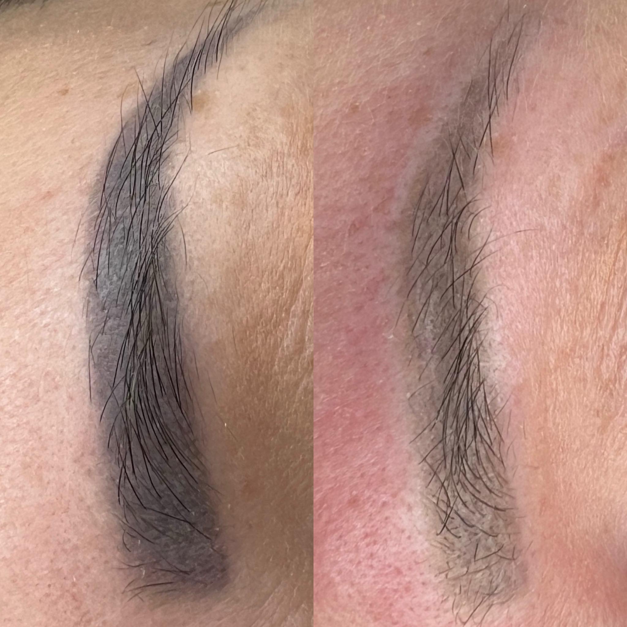 Usuwanie brwi PMU przed i po – Hello Beauty Kołobrzeg