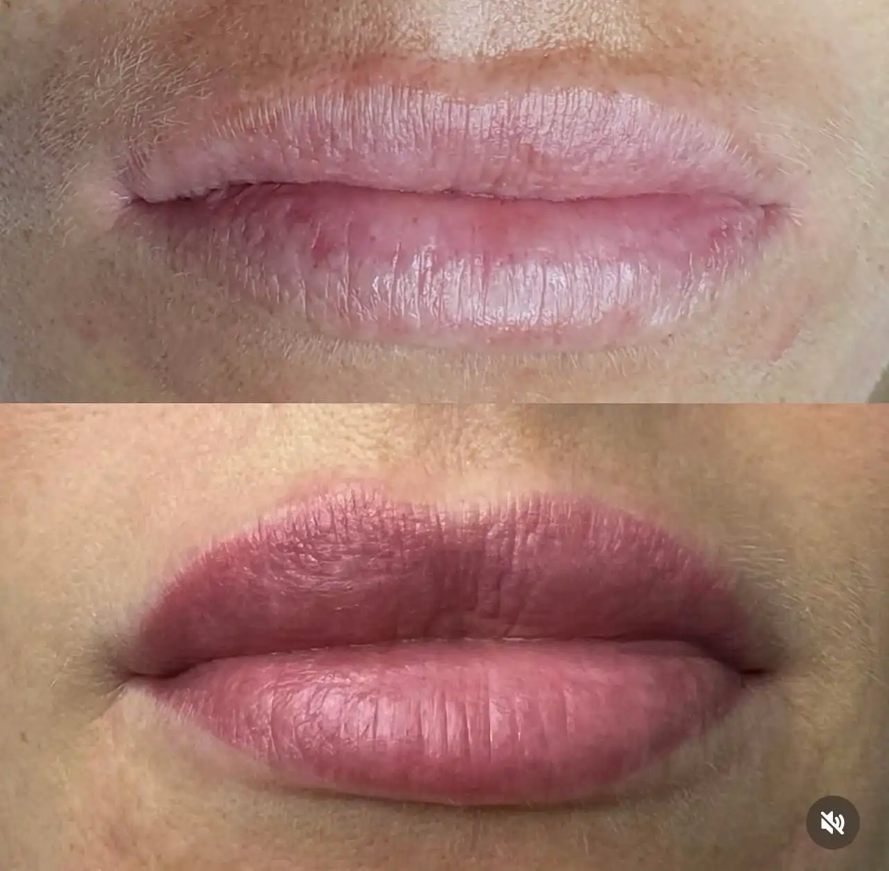 Wygojone usta permanentne przed i po – efekt Hello Beauty